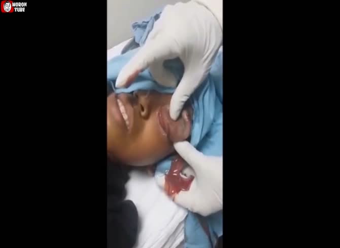 Video :A pus-filled eye! (Informed by the public)